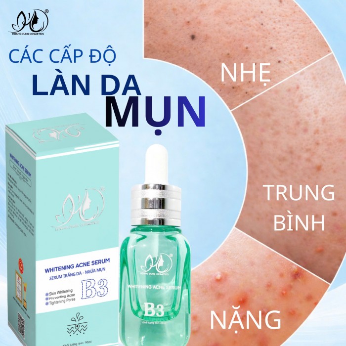 Serum mặt HD HOÀNG DŨNG ngừa mụn trắng da 20ml
